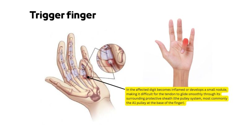Trigger finger