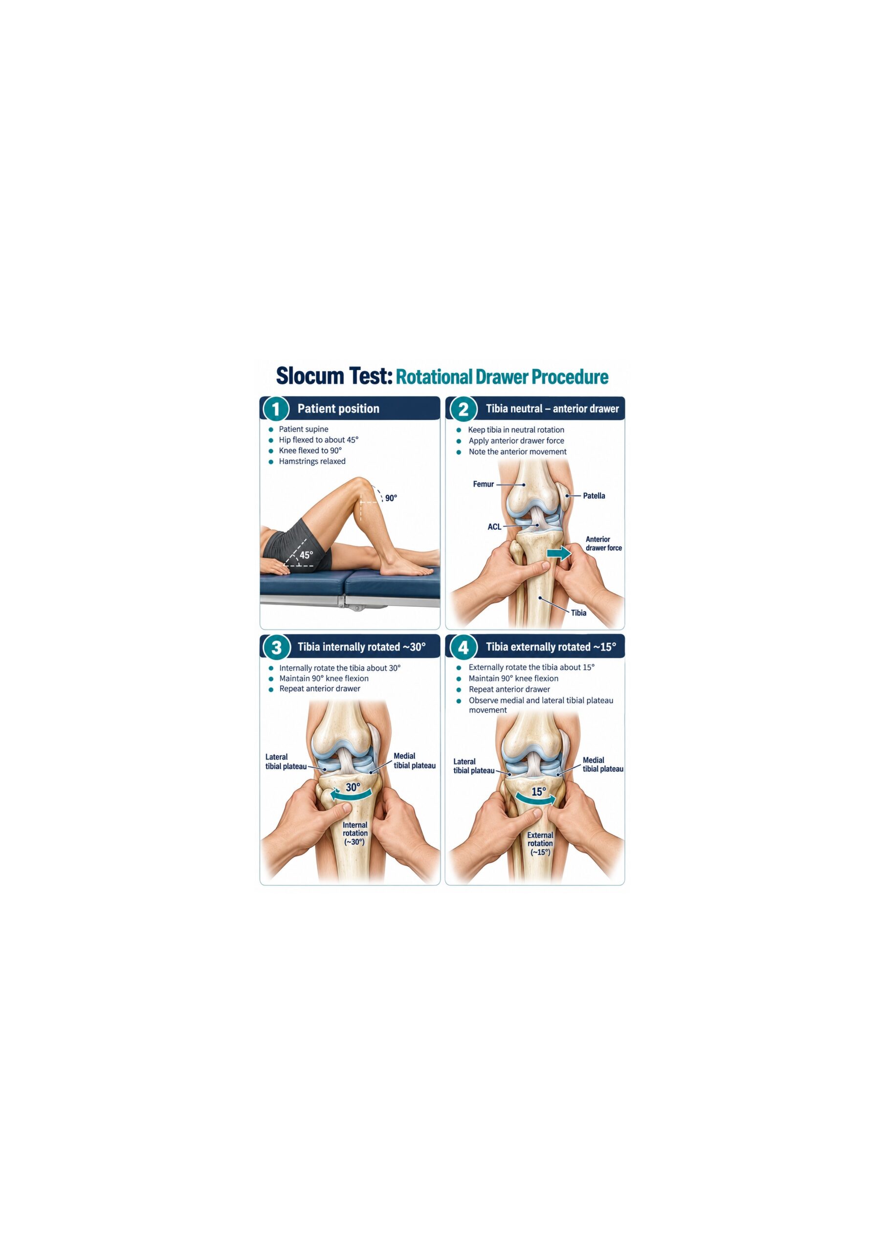 Slocum Test positions in neutral, internal rotation, and external rotation with anterior drawer force