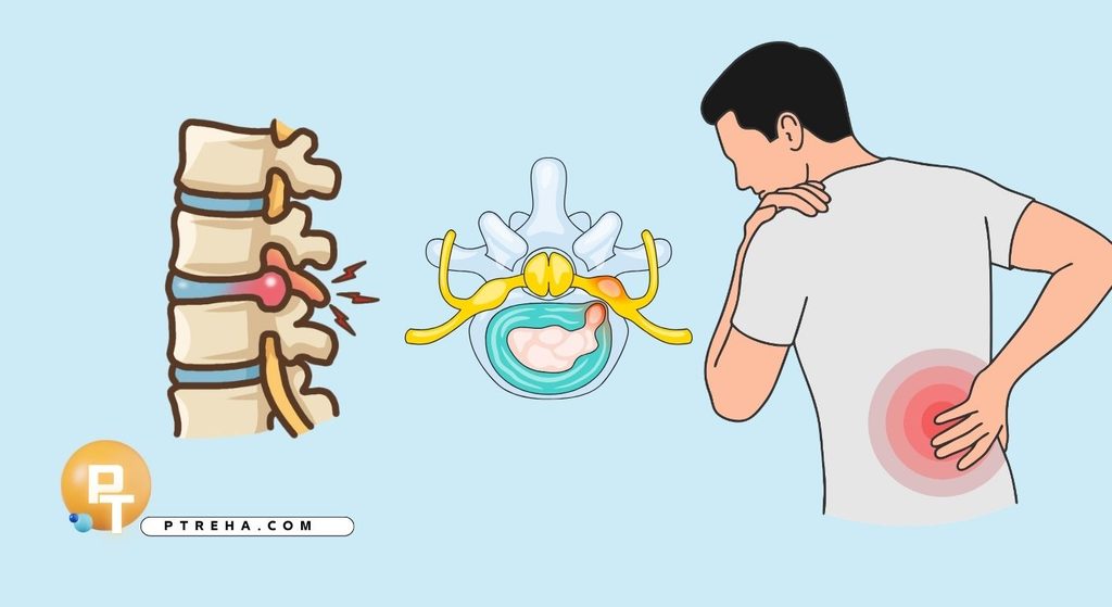 Back pain
