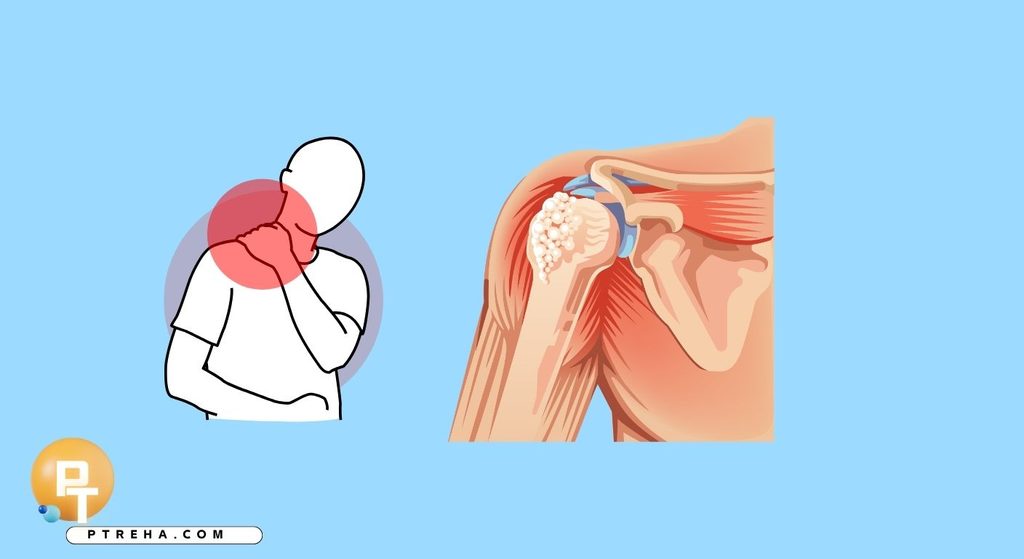 Frozen shoulder