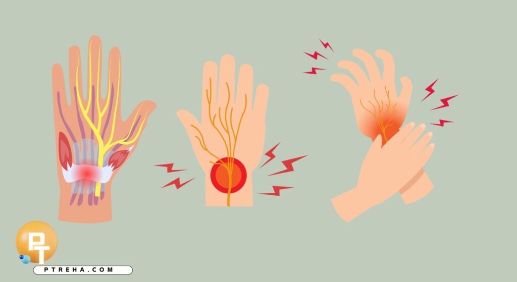 Carpal Tunnel Carpal Tunnel