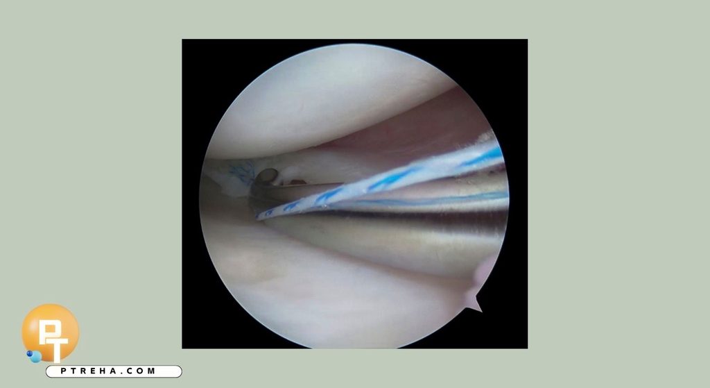 Meniscus Meniscus