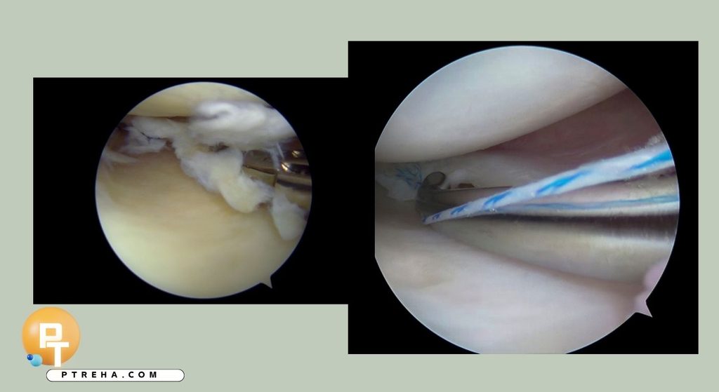 Meniscus Meniscus