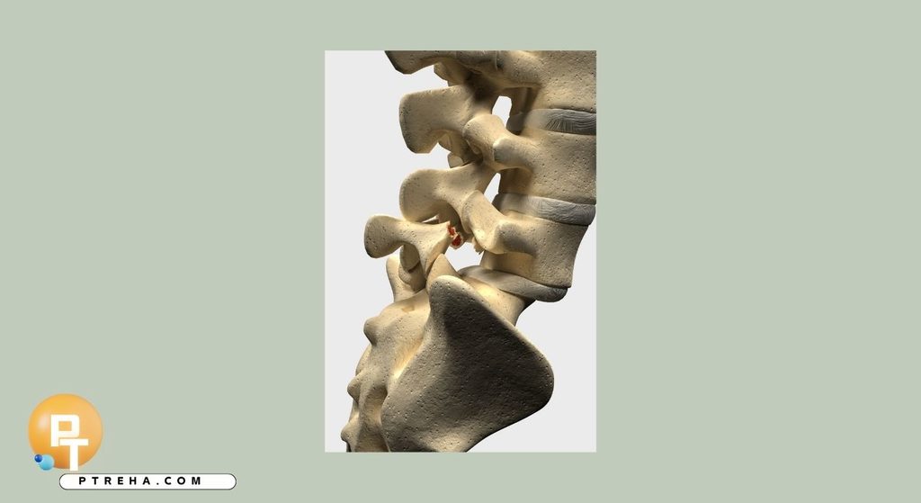 Spondylolisthesis Spondylolisthesis