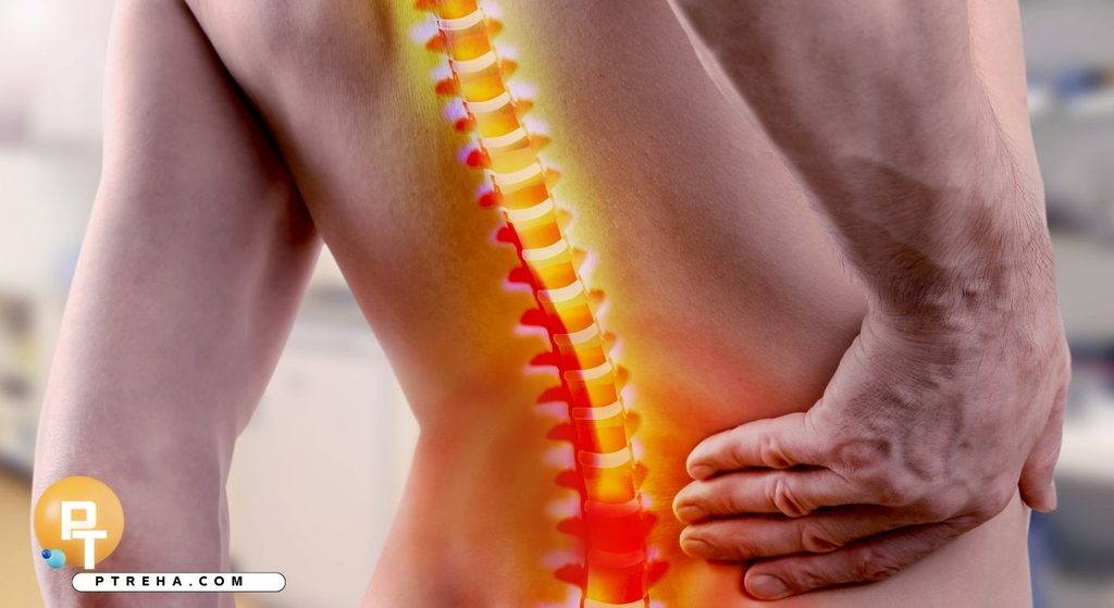 Sciatica