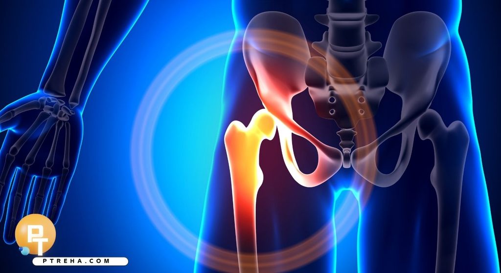 Hip impingement