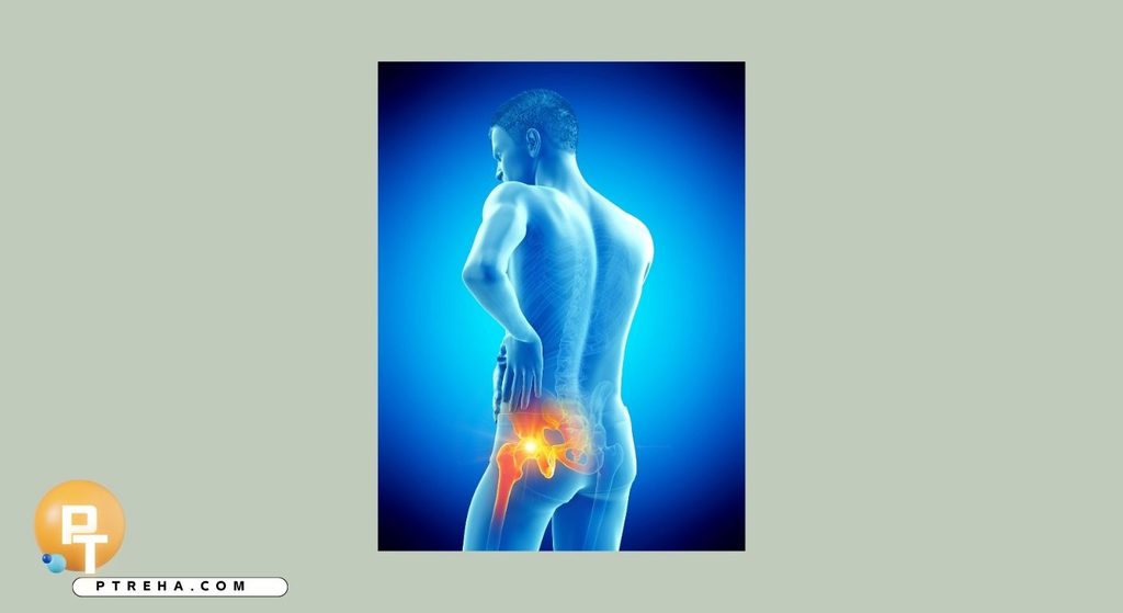 Sciatica