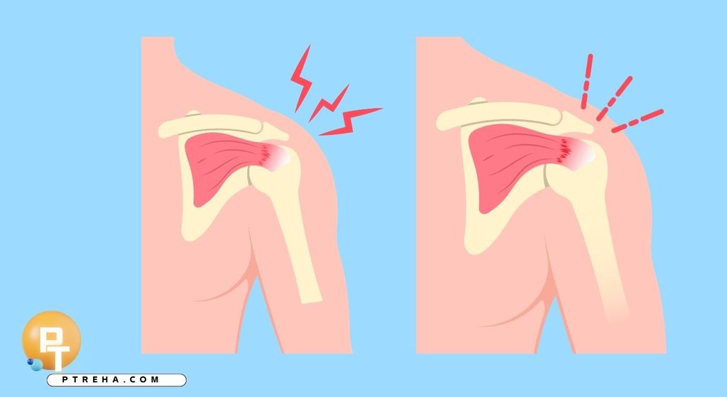 Frozen shoulder