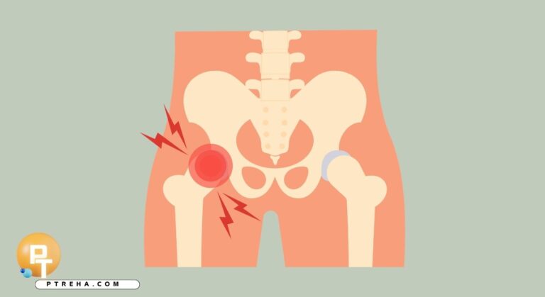 Hip impingement