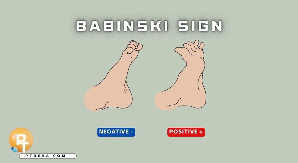 Babinski Sign