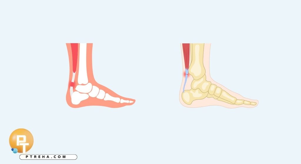 Achilles tendinopathy Achilles tendinopathy