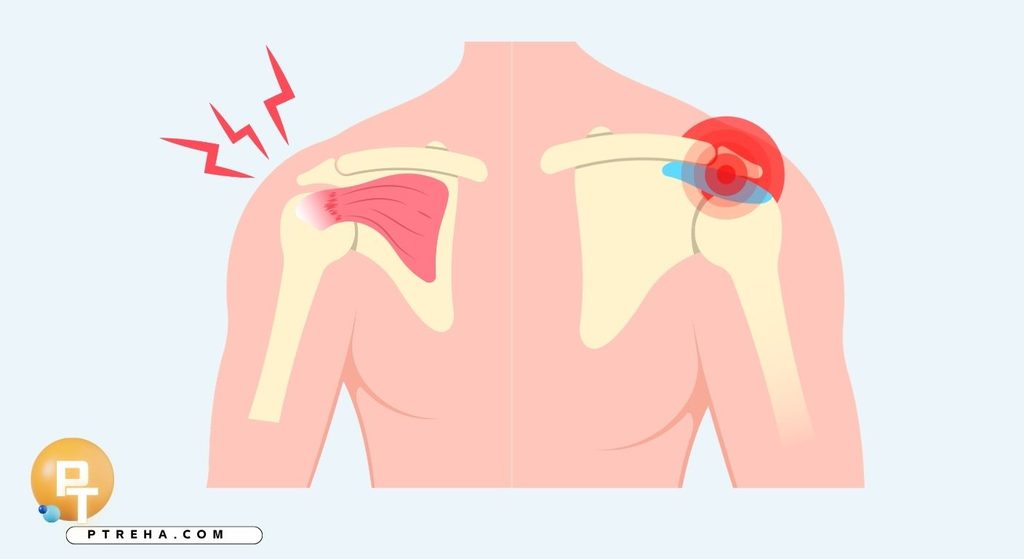 Rotator cuff