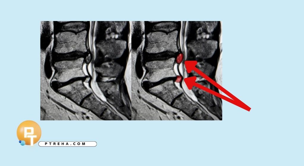 Back pain
