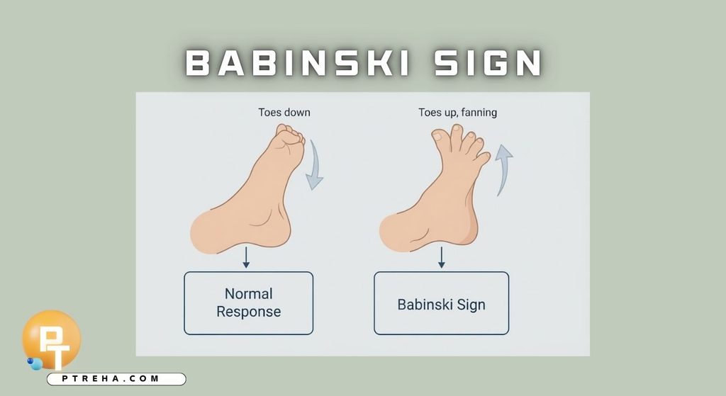 Babinski Sign