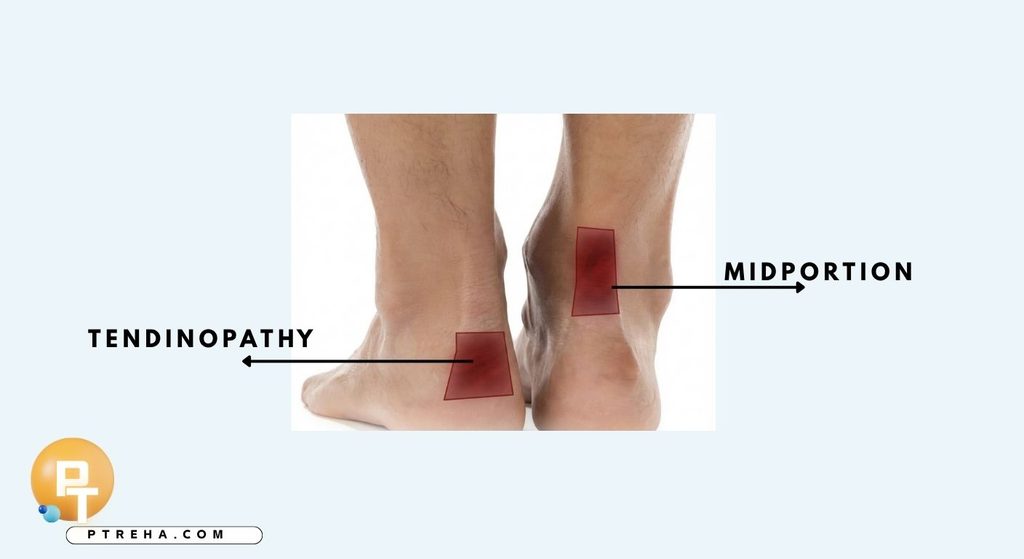 Achilles tendinopathy Achilles tendinopathy