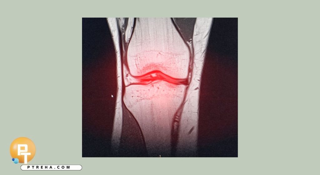 Meniscus Meniscus
